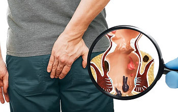 Piles Treatment by Dr. Ashish Anand