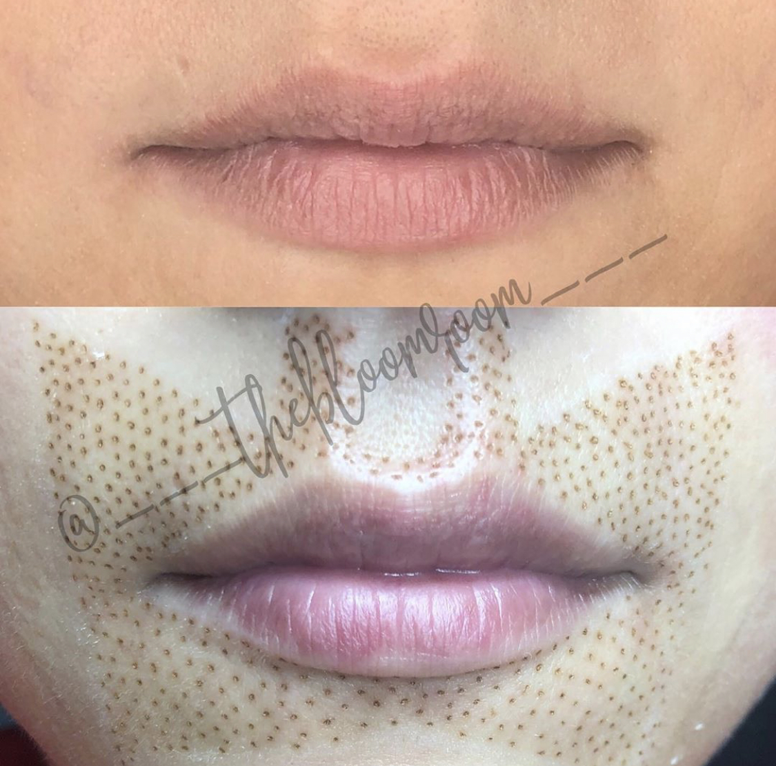 Fibroblast Skin Tightening Bevely Hills