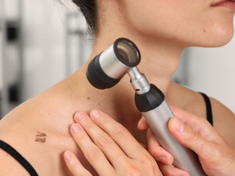Free Mole Check Service Launched To Boost Skin Cancer Awareness On The Isle Of Wight