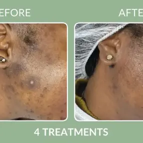 Close-up of hyperpigmentation on a jawline before and after four treatments