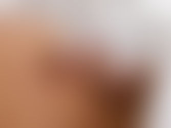 What is Cupping and How Is It Related to Acupuncture?