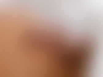 What is Cupping and How Is It Related to Acupuncture?