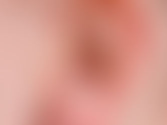 Auricular Acupuncture…With or Without Needles