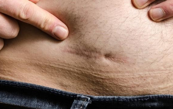 Gastric-Sleeve-Scars-–-Are-They-Big-and-Will-They-Go-Away.jpg