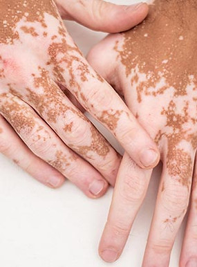 12419-vitiligo.jpg