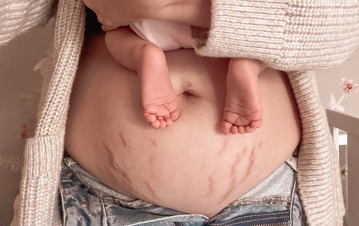Pregnancy-Stretch-Marks-_-During-and-After-What-to-Expect.jpg