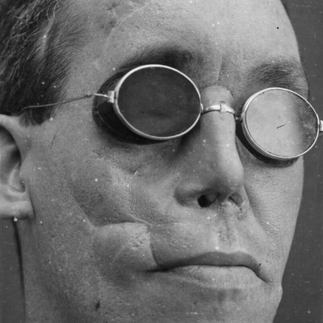 Man with severe facial disfigurement wearing round dark glasses.