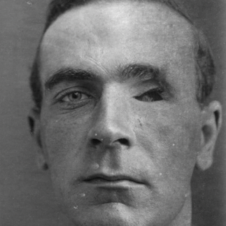Black and white portrait of a man with a missing left eye.