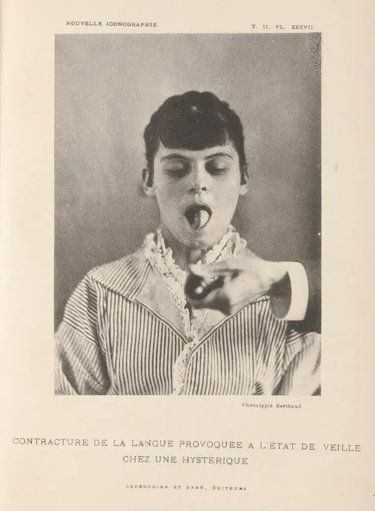 Black and white image of a person sticking out their tongue, eyes closed. They wear striped clothing. French text at the bottom discusses hysteria.