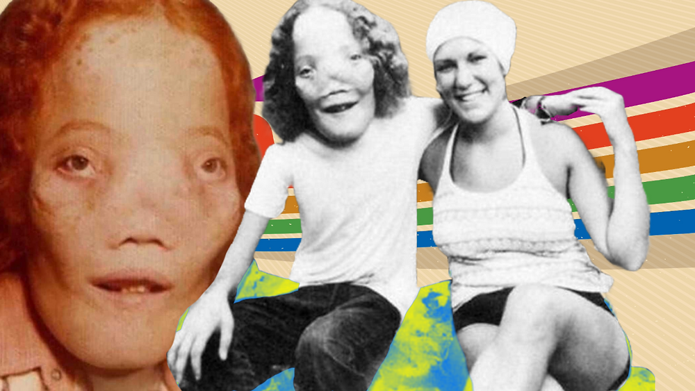 The Real Story of Rocky Dennis: Beyond the Film Mask