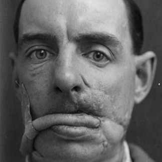 Man with severe facial injuries and disfigured mouth, resting chin on fist.