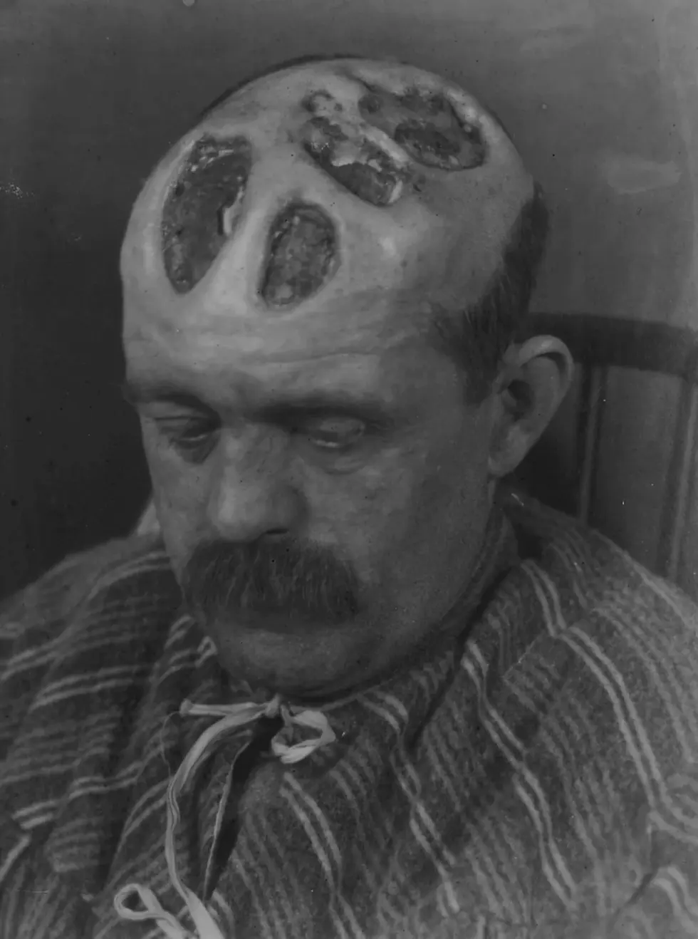Seated man with open head wounds displaying surgical treatment. Somber expression, wearing a striped garment. Neutral, plain background.