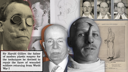 Collage of Sir Harold Gillies with patients, surgical diagrams, and drawings, highlighting his pioneering plastic surgery for WWI soldiers.