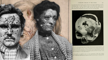 When Syphilis Was a Death Sentence: The Haunting Reality Before Penicillin