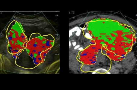 University of Cambridge Scientists' Virtual Biopsies could replace tissue biopsies in future.