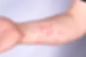 Mpox no Brasil acende alerta para novos casos; Saiba como identificar