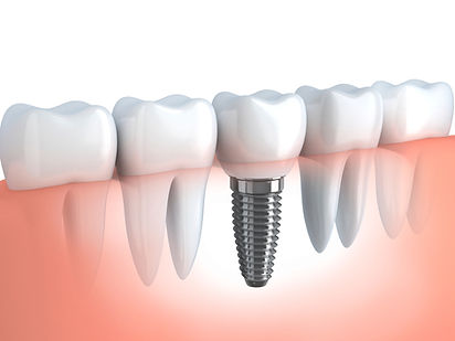 Dental implant below gums view