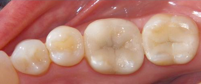 Composite fillings