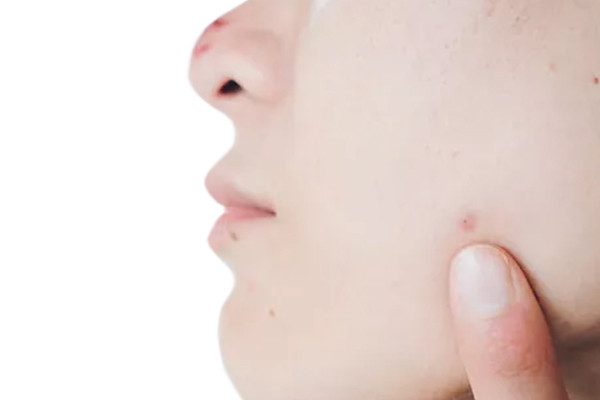 Menghapus Bekas Jerawat Jarum Mikro Perawatan Laser Atau Keduanya