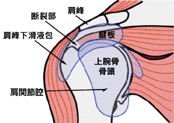 腱板断裂.gif