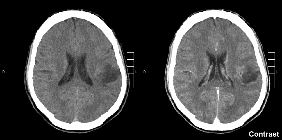 Beyinde Düşük Grade Gliyoma Tümörlerinde Biyopsi Ya Da Çıkarma