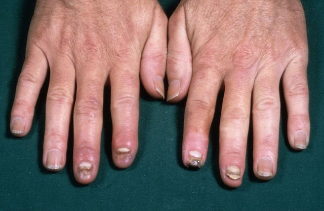 Buerger hastalığı. Foto: Wellcome Images