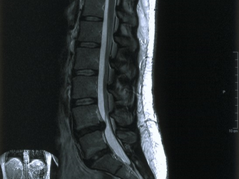 Spinal Disk Hasarı Nedenli Bacak Ve Bel Ağrısında Cerrahi