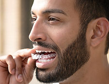Man-Invisalign-Aligner-1.jpeg