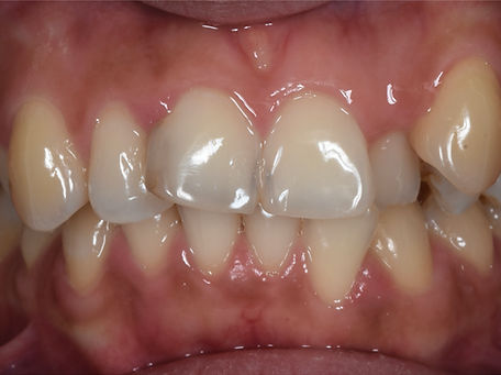 Braces Pre Treatment Photo