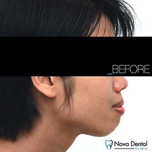 Bimaxillary Facial Profile
