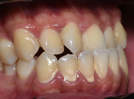 Braces Pre Treatment Photo