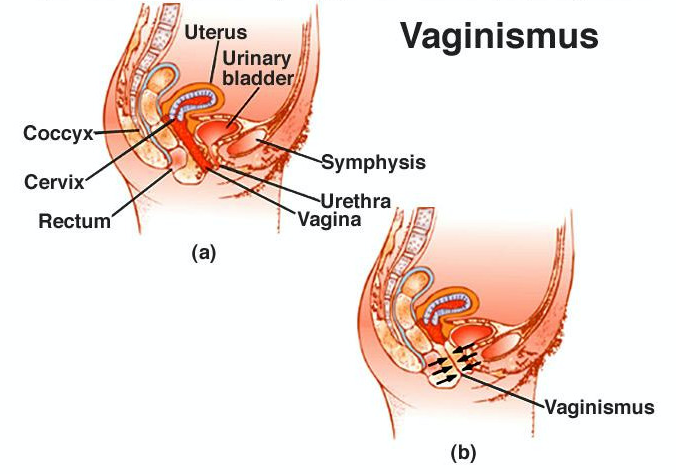 Vaginismus anatomy