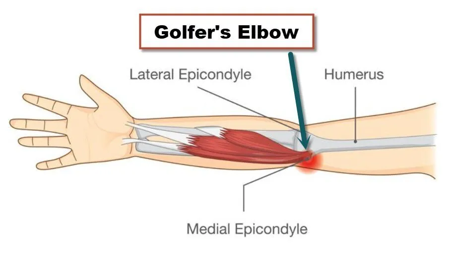 golfers-elbow-treatment