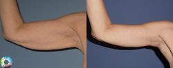 arm-lift-442-view-1-detail
