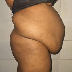Check out this incredible transformation! Our liposuction procedure helped this patient ac