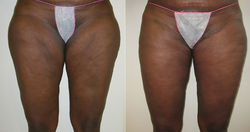 thigh-lift-gallery