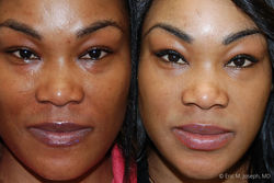 Blepharoplasty-0008