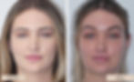 Botox Brow Lift Before and After