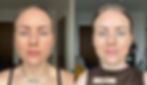 Botox Brow Lift Before and After