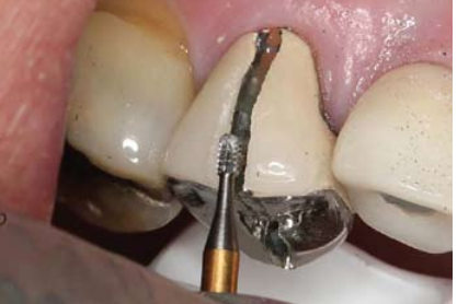 Mr Bur, mrbur, dental burs, burs, burr, dental supplier, carbide burs, diamond burs, dental supplies manufacturer, crown preparation burs, surgical burs, white stone burs, scaler machine, minor oral surgery, dental instruments, scaler tip, dental care, round bur, Inverted Cone bur, Cylinder bur, Fissure bur, Taper Flat end bur, taper round end bur, Pointed Cone bur, Bevel bur, preparation bur, Pear bur, Donut bur, Occusal Surface bur, fine Finishing Diamond bur, super fine Finishing Diamond bur, Endodontic bur, endo-z, Specialty bur, Oral Surgical bur, Diamond Disc, HP MOS Burs, HP Tungsten Carbide, Hybrid Crown Removal, FG Gold Bur, Silicon, Stone, Polisher, Diamond Polisher, Laboratory, IPR, Ultrasonic Inserts