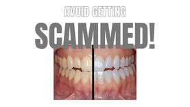               Get Whiter Teeth at Home