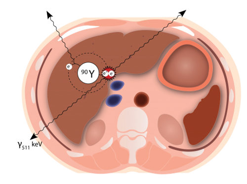 Y90-liver-e1501743718992.png