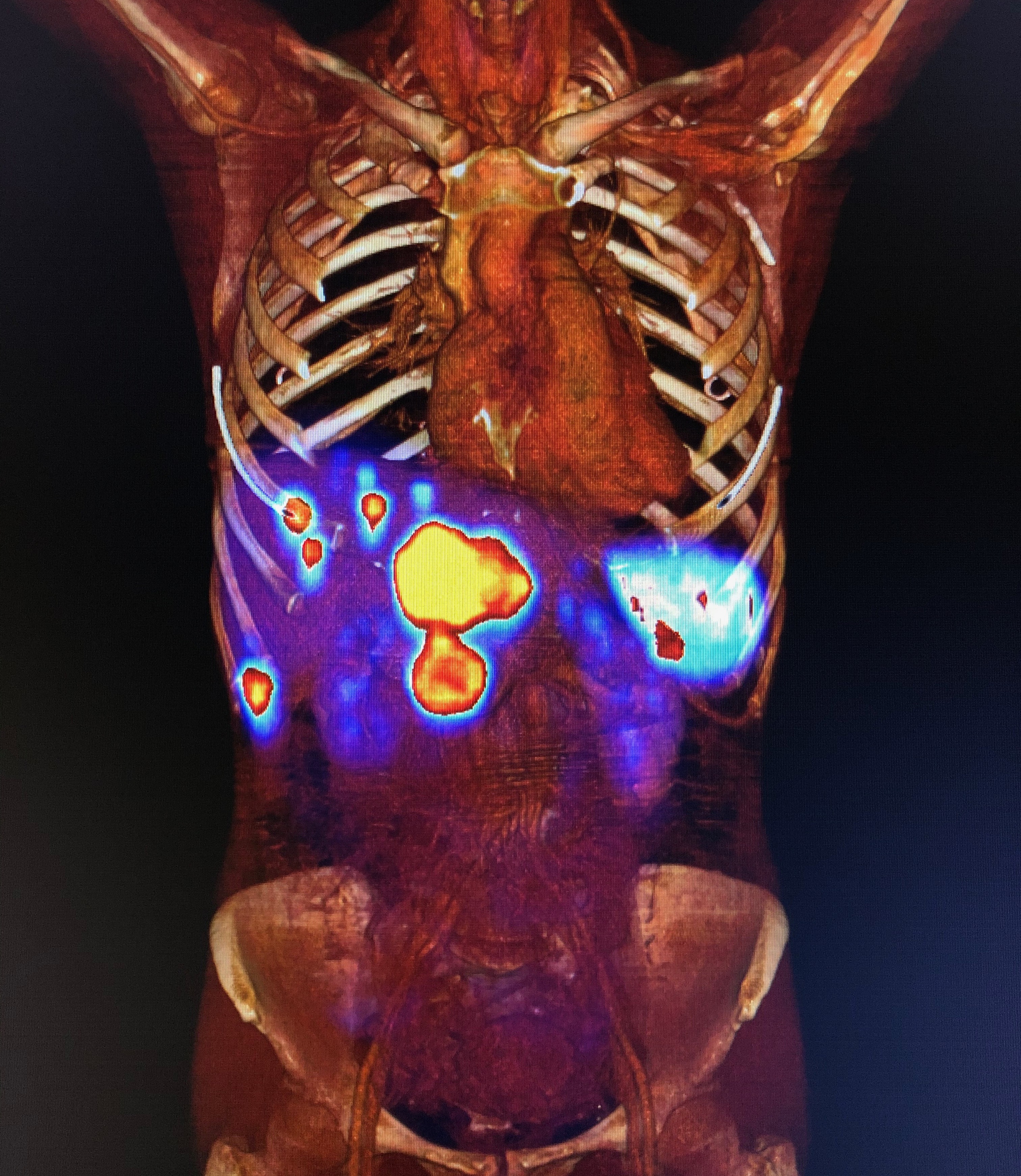 Galyum DOTATATE PET CT
