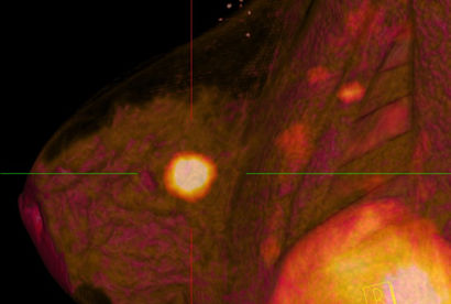 PET CT