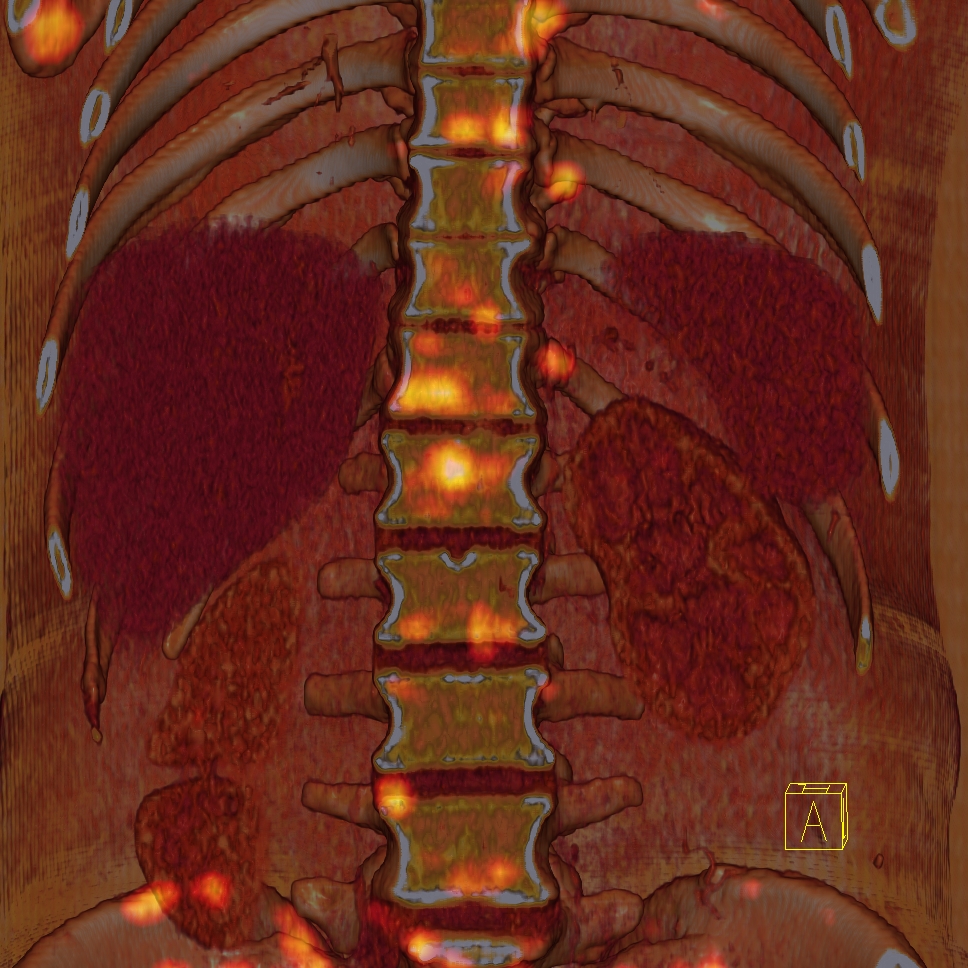 PETCT hasta örnekleri I Prof. Dr. Akın Yıldız