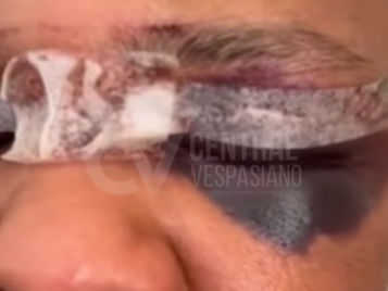 Corte no rosto por linha com cerol.