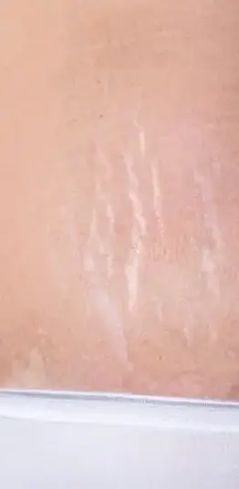 stretch mark treatment