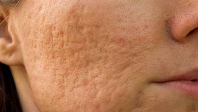acne scar treatment in nanaimo
