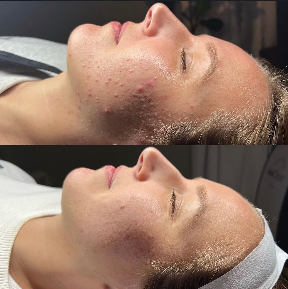 chemical peel for acne parksville