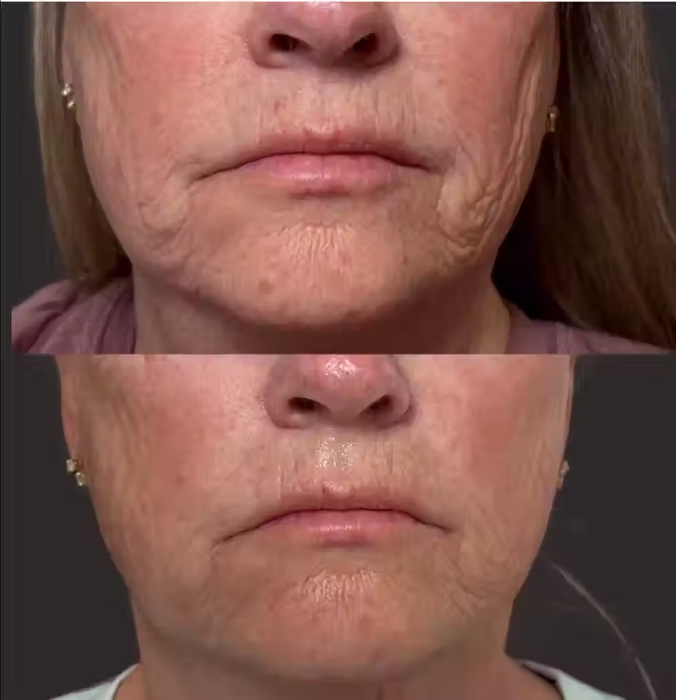 sagging jowls treatment
